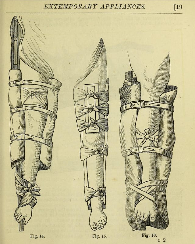 Illustration from "The surgeon's pocket-book: Being an essay on the best treatment of wounded in war" by J. H. Porter (1875) 