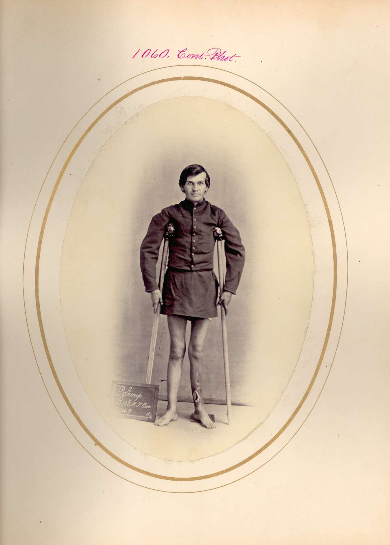 Peter Shrup. Shell wound of left leg lower third fracturing tibia. PVT, Company B, 16th New York Cavalry. Wounded April 5, 1865 at the Battle of Fort Hell, Virginia. (via National Museum of Health and Medicine)