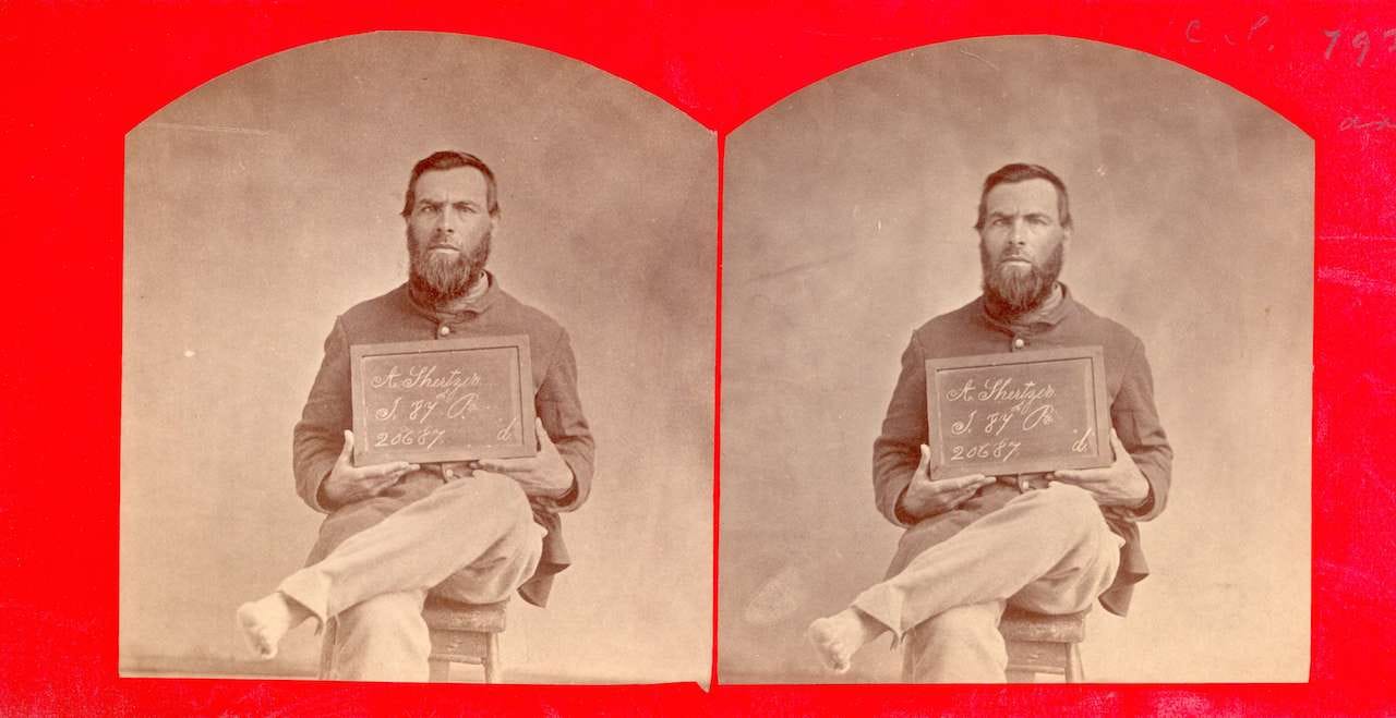 Aaron Shertzer. Axe wound of left foot. PVT, Company J, 87th Pennsylvania. (via National Museum of Health and Medicine)