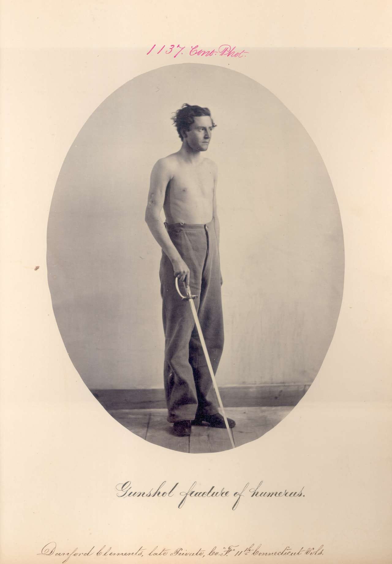 Danford Clements. Gunshot fracture of humerus. PVT, Company F, 11th Connecticut Volunteers. (1866) (via National Museum of Health and Medicine)