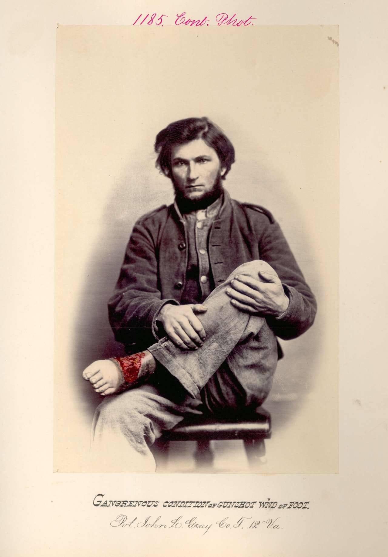 John L. Gray, "Gangrenous condition of gunshot wound of foot. PVT, Company F, 12th, Virginia Infantry. Injured at the 1864 Battle of Petersburg" (via National Museum of Health and Medicine)