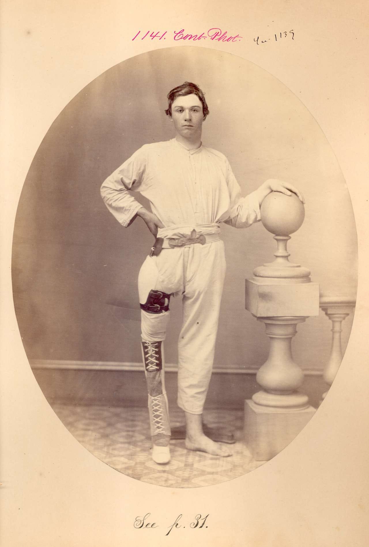 Jason W. Joslyn, "Excision of head & 4 inches of shaft femur, prosthesis in place. PVT, Company I, 7th New York Heavy Artillery. Injured at 1864 Battle of Cold Harbor" (via National Museum of Health and Medicine)