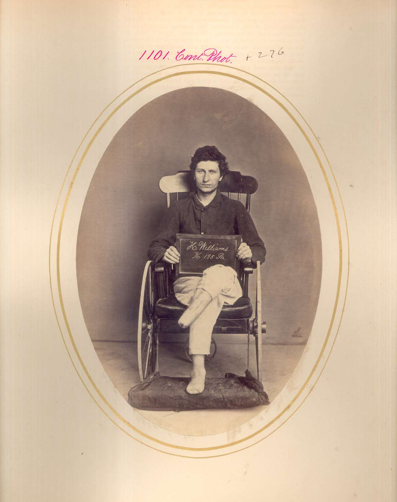Hiram Williams. Amputation of leg and foot, shell wound. PVT, Company K, 98th Pennsylvania Volunteers. Injured at the 1865 Battle of Appomattox. (via National Museum of Health and Medicine)
