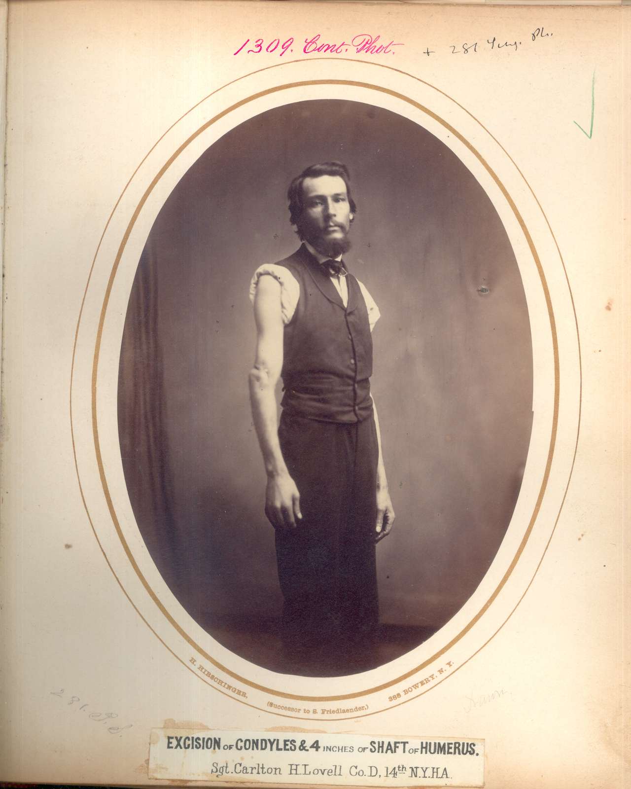 Sgt. Carlton H. Lovell, 14th New York Heavy Artillery. Wounded June 2, 1864 at the Battle of Cold Harbor, Virginia. Photographed by H. Hirschinger at 388 Bowery, New York. (via National Museum of Health and Medicine)