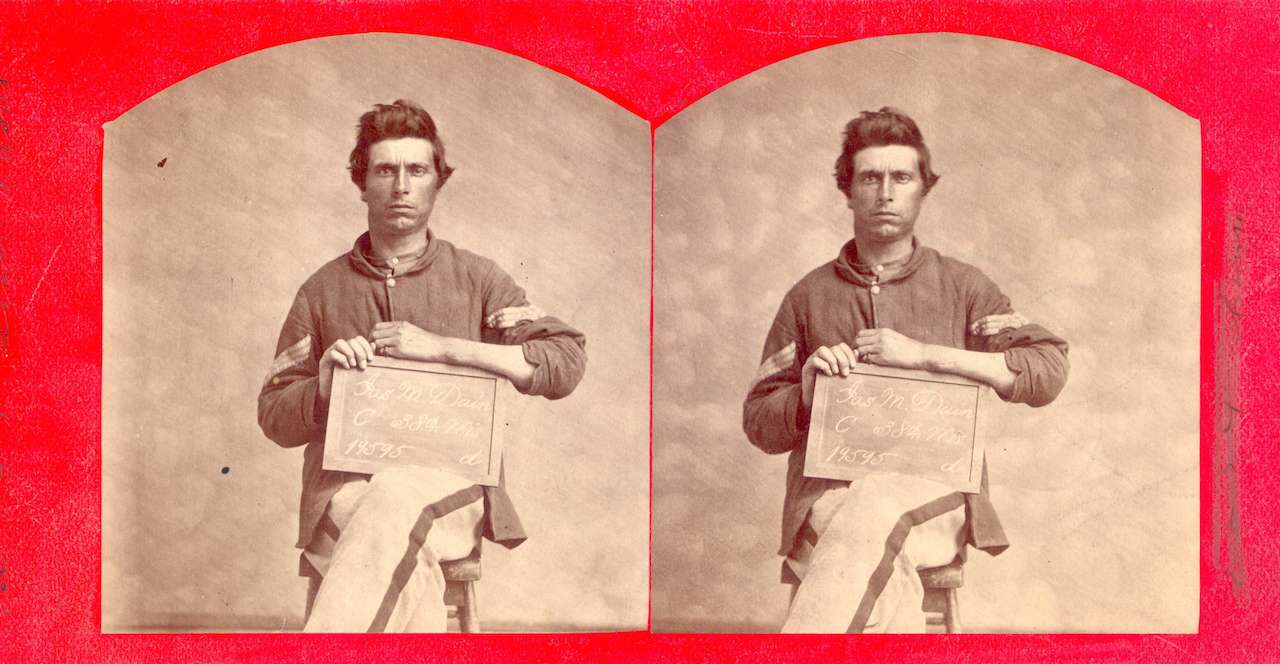 J. M. Dain. Excision of forearm due to shot fracture. SGT, Company C, 38th Wisconsin. Wounded December 8, 1864. (via National Museum of Health and Medicine)