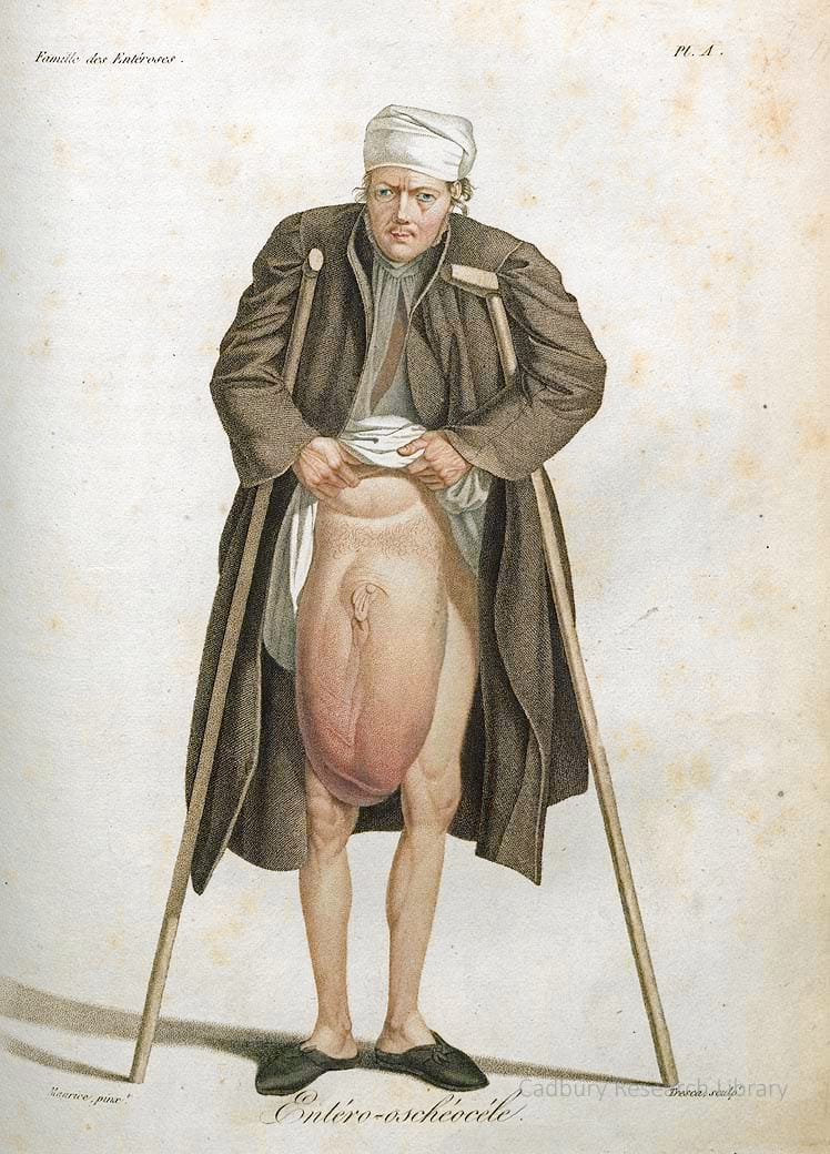 Entero oscheocele, Nosologie Naturelle, Jean-Louis Alibert, 1806 Cadbury Research Library