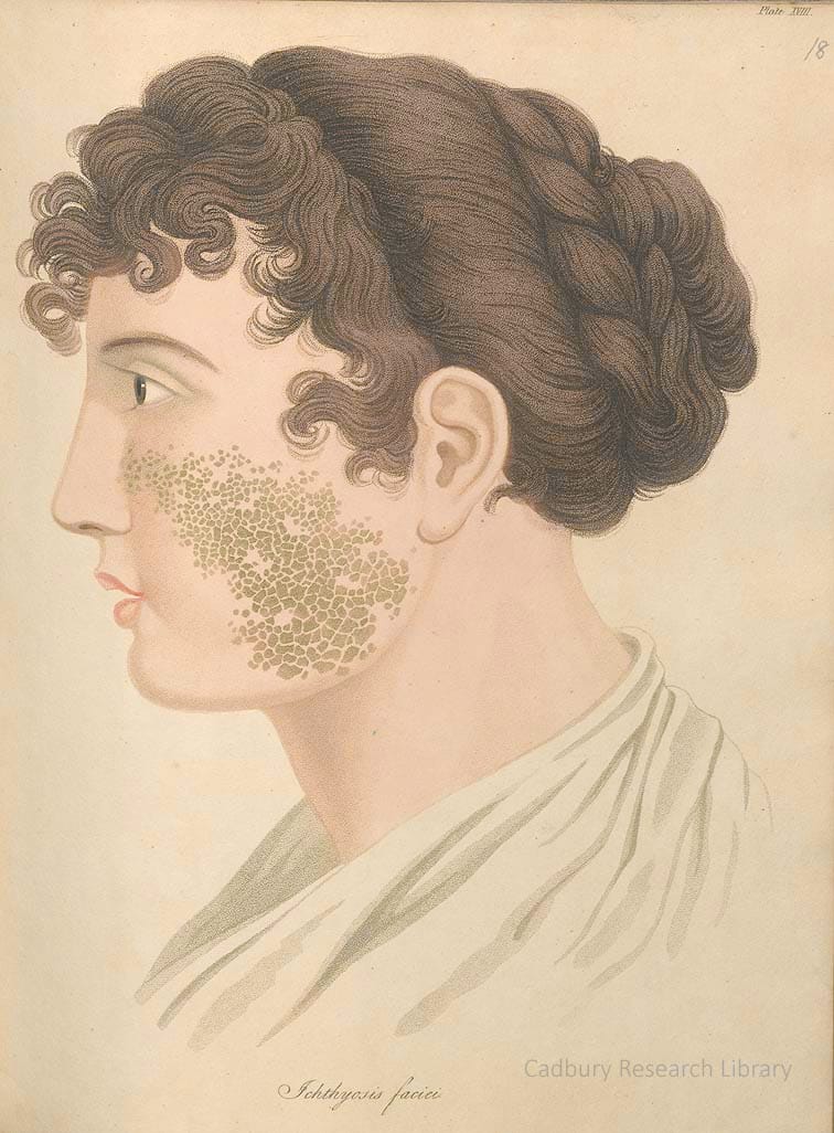 Ichthyosis faciei, from Thomas Bateman's 'Delineations of Cutaneous Diseases' (1828)