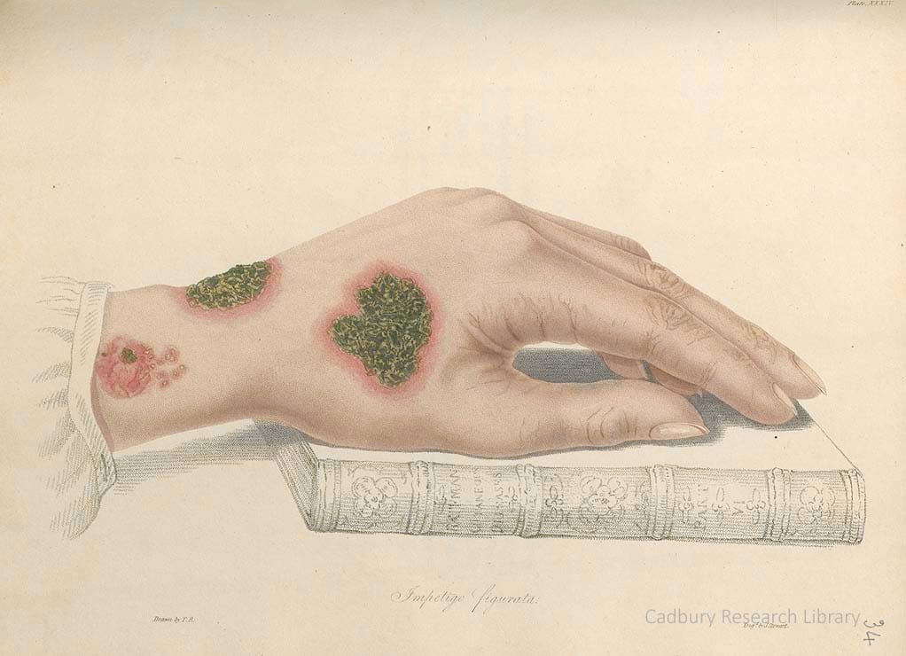 Impetigo, hand on book, from Thomas Bateman's 'Delineations of Cutaneous Diseases' (1828)