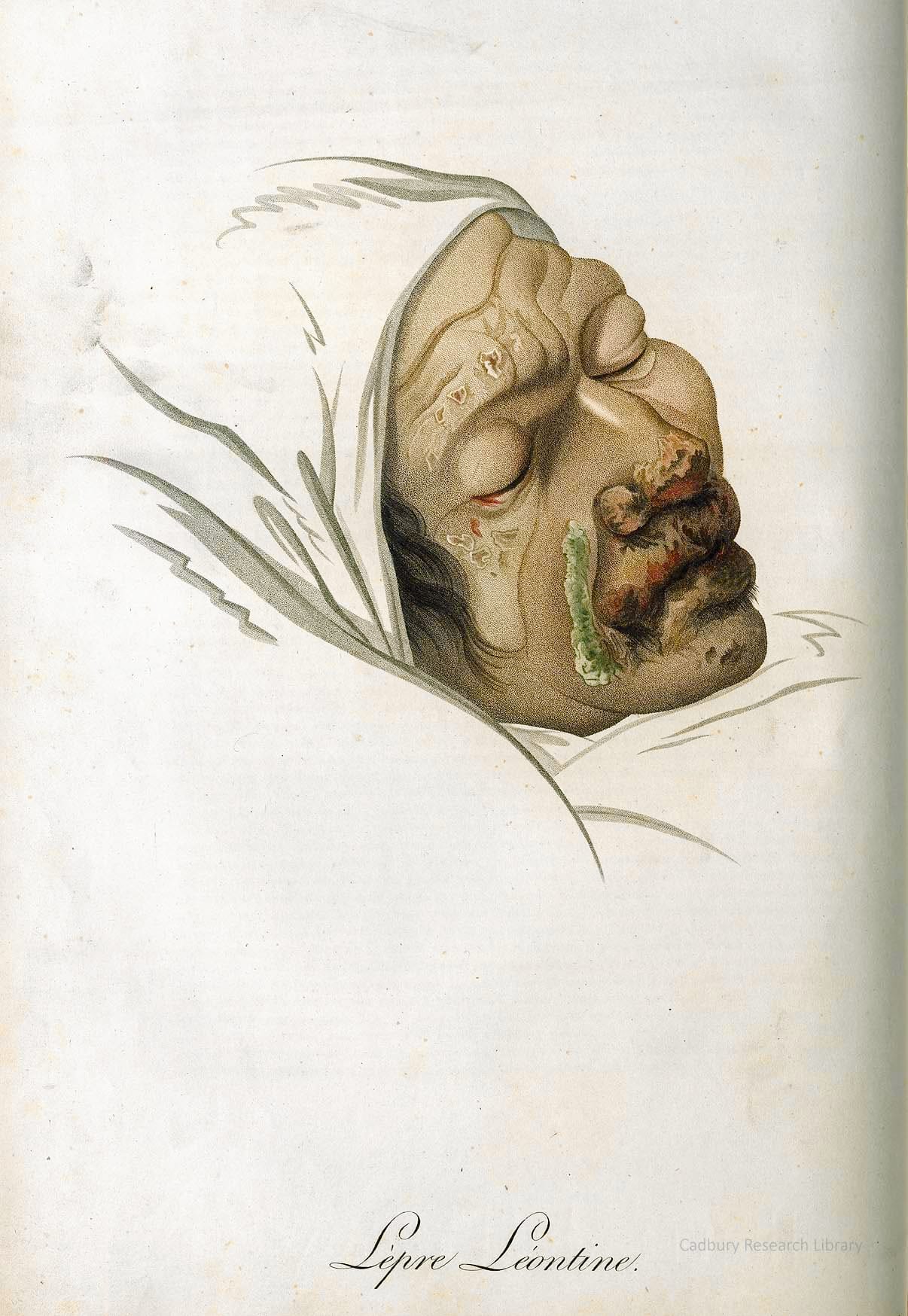 Lepre Leontine, Descriptions des maladies de la peau Cadbury Research Library