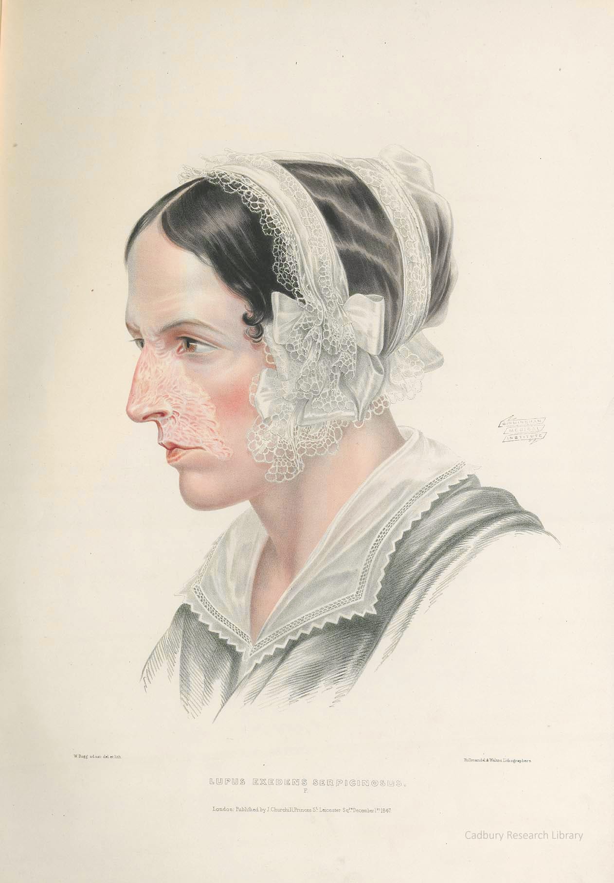 Lupus, Portraits of Diseases of the Skin, Sir Erasmus Wilson Cadbury Research Library