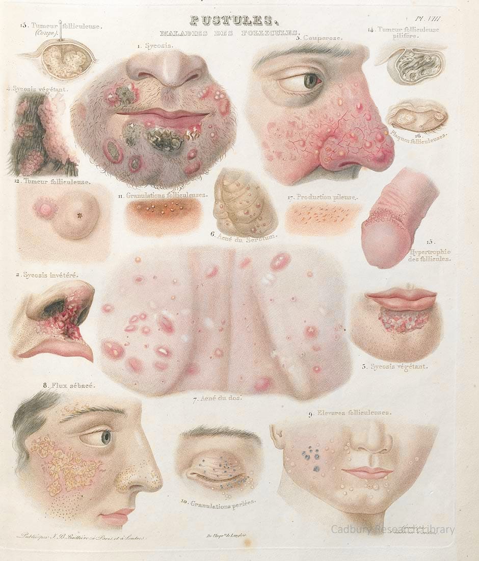 Pustulae, Treatise on the Diseases of the Skin, Rayer, 1835, plate VIII Cadbury Research Library