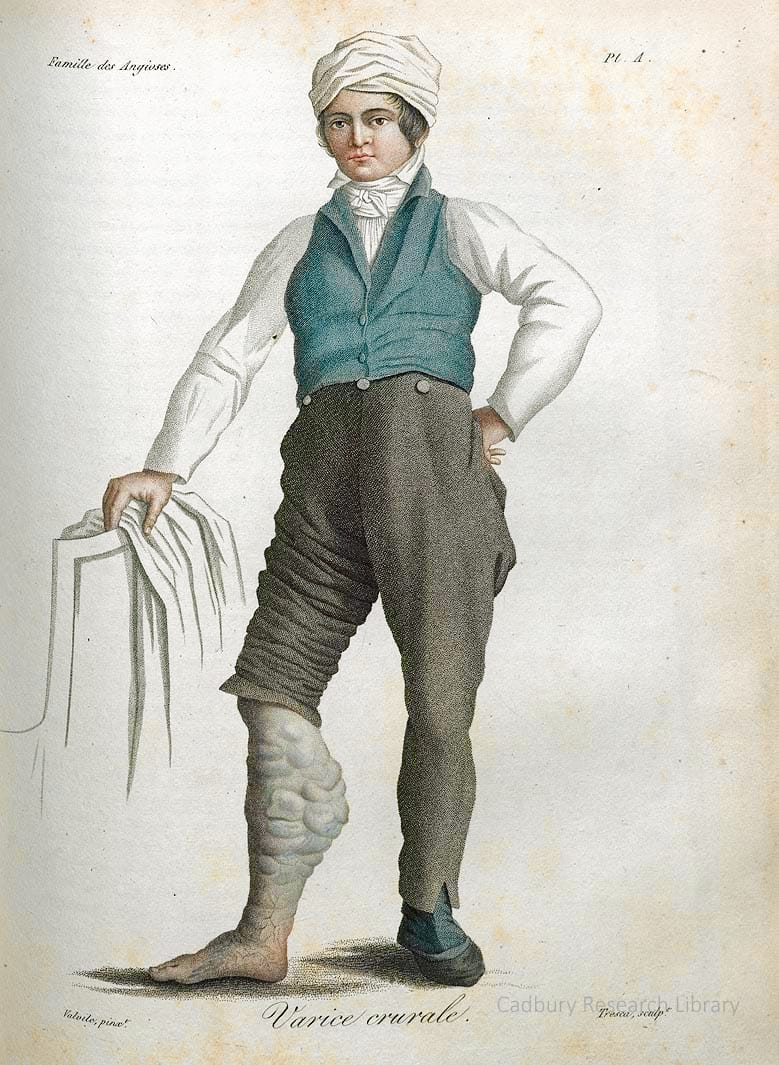 Varice crurale, Nosologie Naturelle, Jean-Louis Alibert, 1806 Cadbury Research Library