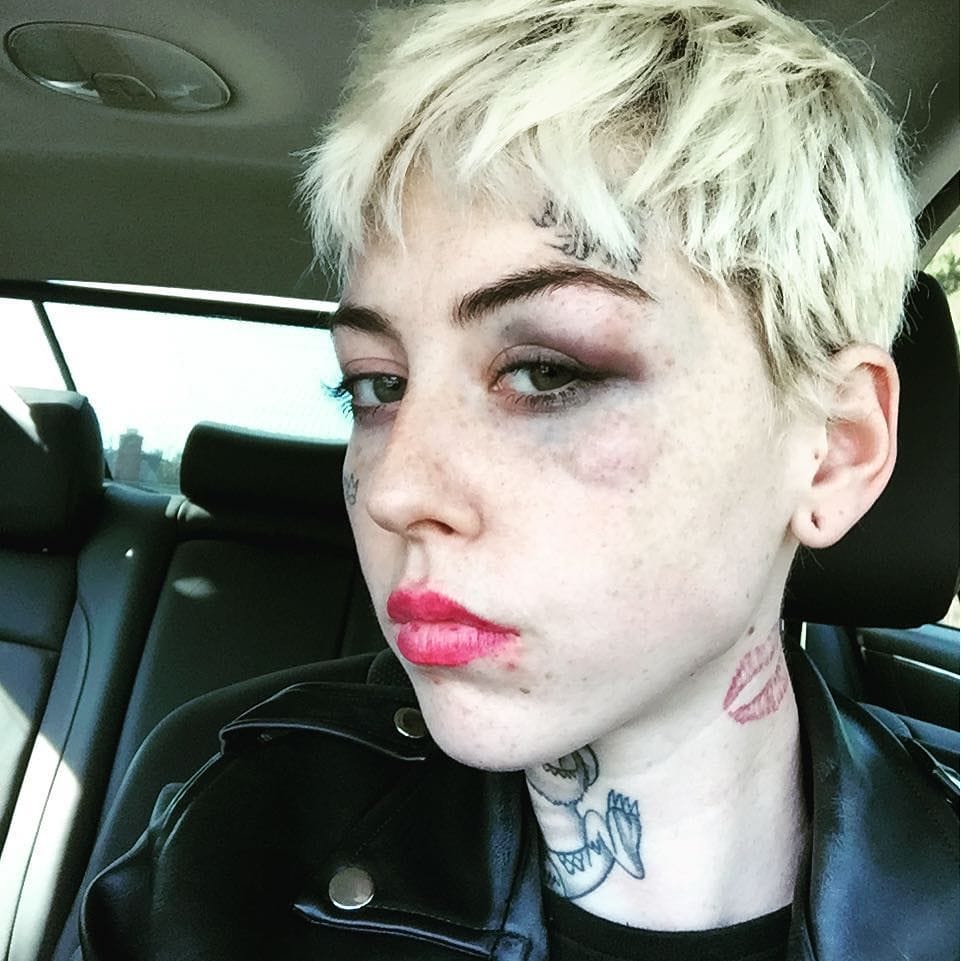 Artist Illma Gore after being assaulted by a Trump supporter (photo via @illmagore/Instagram)