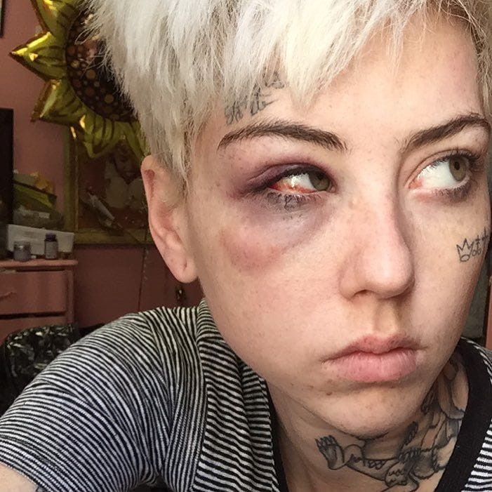 Artist Illma Gore after being assaulted by a Trump supporter (photo via @illmagore/Instagram)