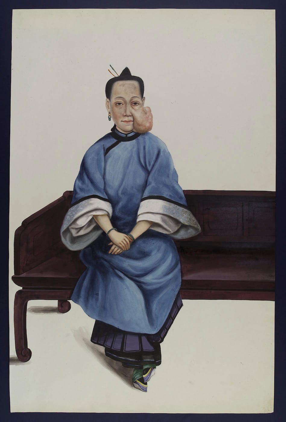 Guan Qiaochang Lamqua, "A Chinese lady (Lo Wanshun) from Canton (Guangzhou) sitting on a couch with a tumour on her left cheek" (via Wellcome Images/Wikimedia)