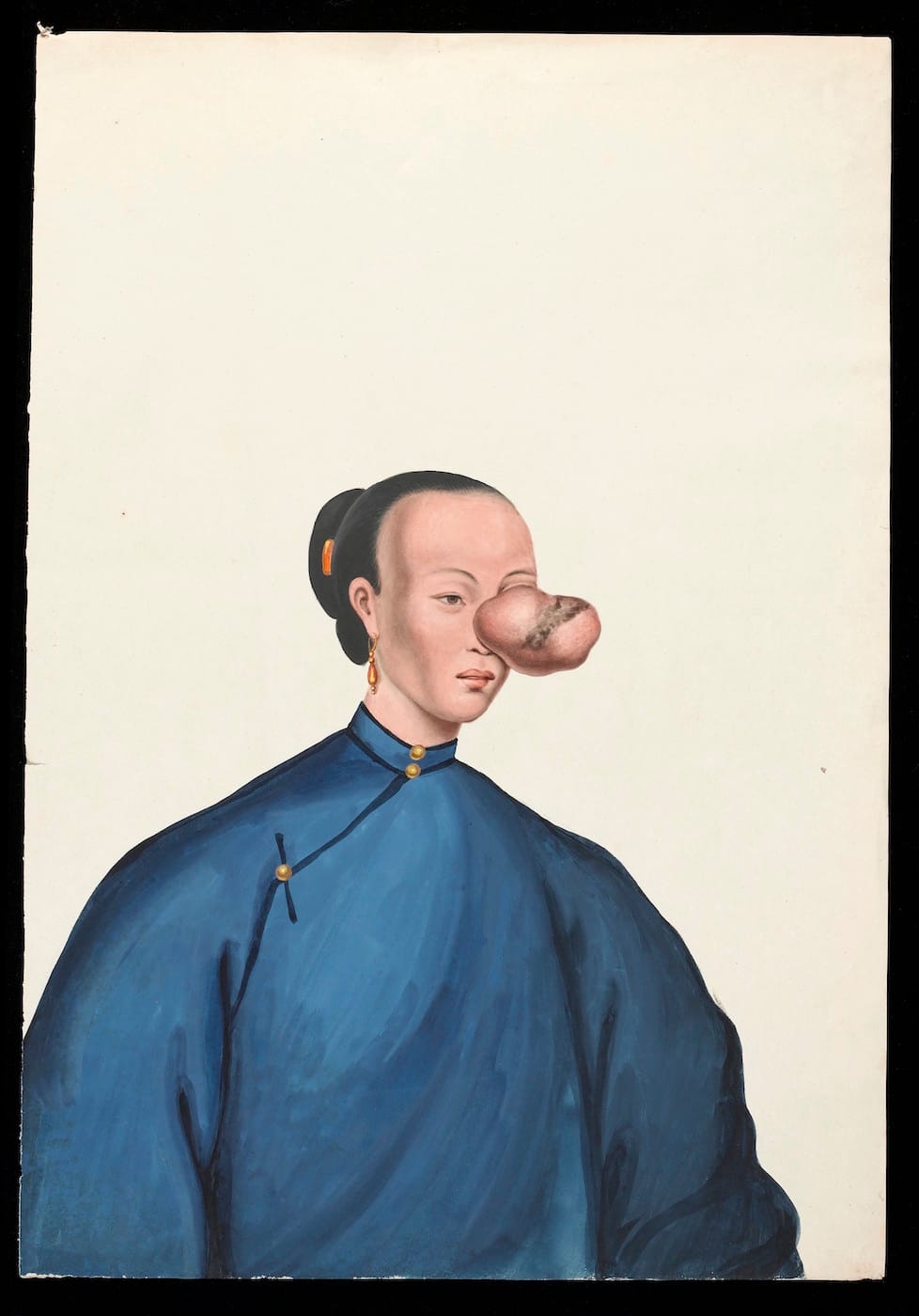 Guan Qiaochang Lamqua, "A woman, facing to right, with a large tumour covering her left eye" (via Wellcome Images/Wikimedia)
