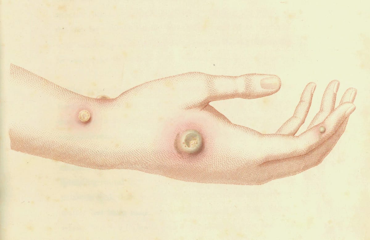 Fascinating Illustrations of 18th-century Inoculations by the Inventor of the Smallpox Vaccine