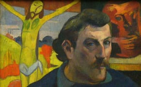 Posthumous Prognosis for Supposedly Syphilitic Gauguin, via His Teeth