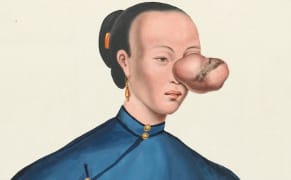 An Unlikely East-West Collaboration in 1830s Portraits of Tumor Patients
